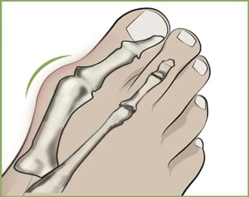 Hallux Valgus Zehenspreizer